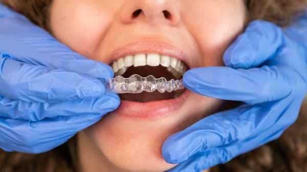  invisalign Kenda 