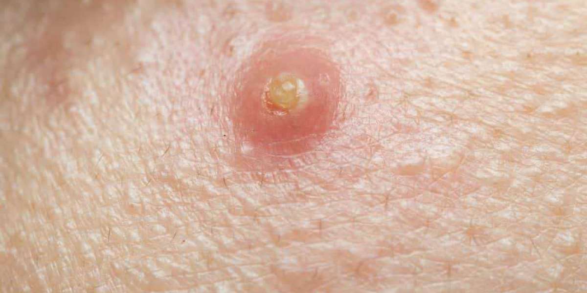 Boils: Causes, Symptoms, and Treatment