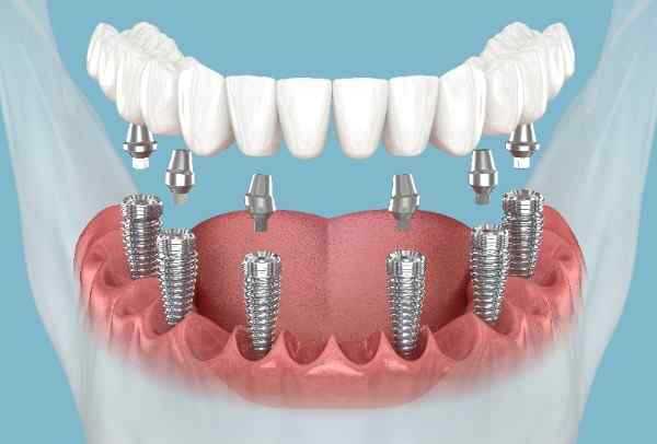  dental implants Kendal 