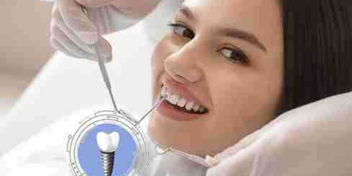 Find Out Whether You're a Good Match for Dental Implants