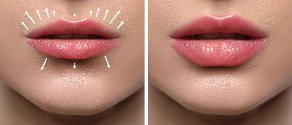 lip filler Newport