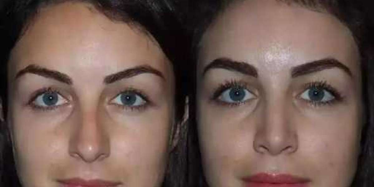 How Rhinoplasty in Dubai Can Improve Facial Harmony