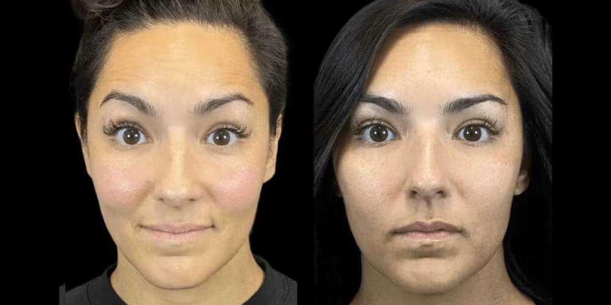 Why the Best Doctors in dubai Recommend Botox for First-Time Users