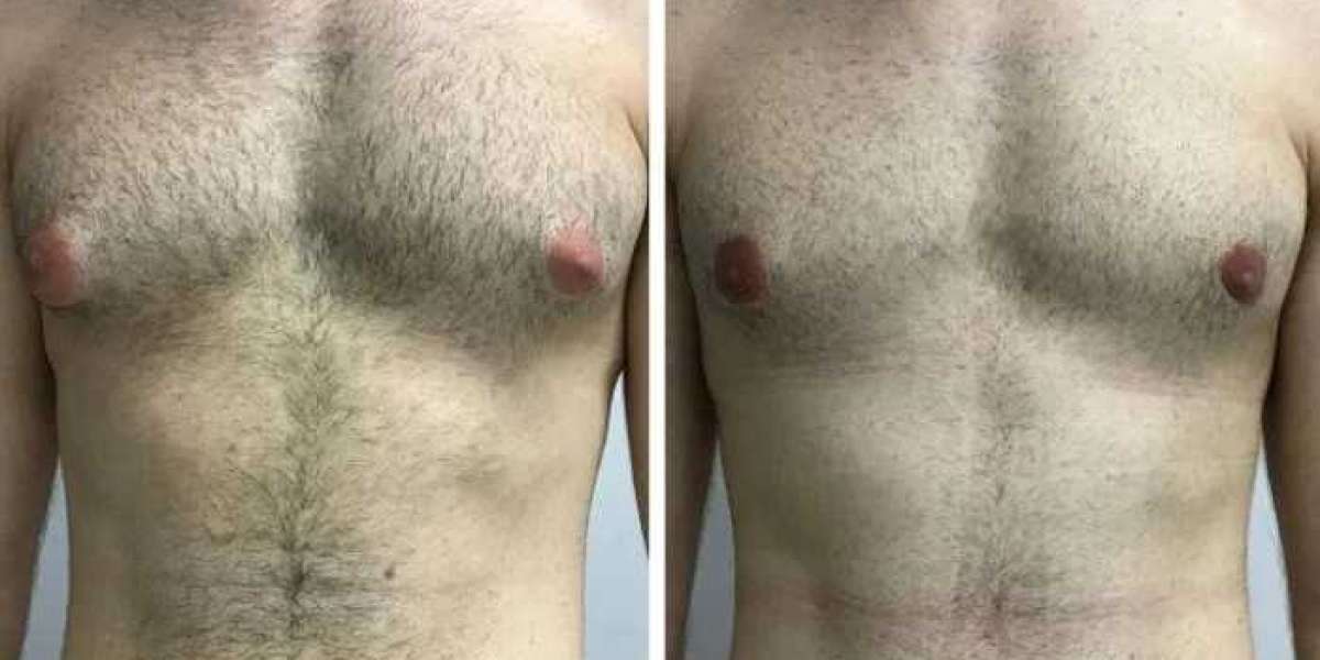 Best Doctors in Dubai: Choosing the Right Surgeon for Gynecomastia