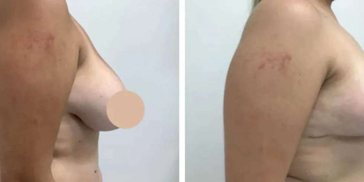 Expertise You Can Trust: The Best Doctors in Dubai for Breast Reduction