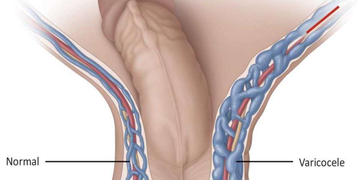 Can Gym Workouts Cause Varicocele? Here's What You Need to Know