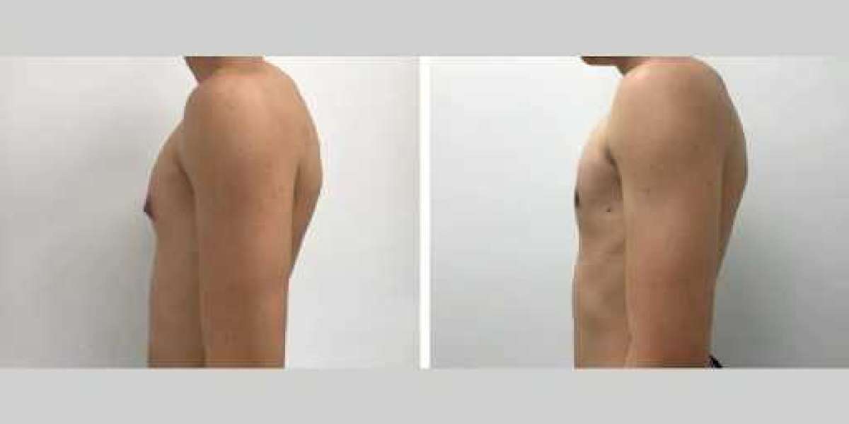 Why Experience Matters: The Best Doctors in Dubai for Male Breast Reduction
