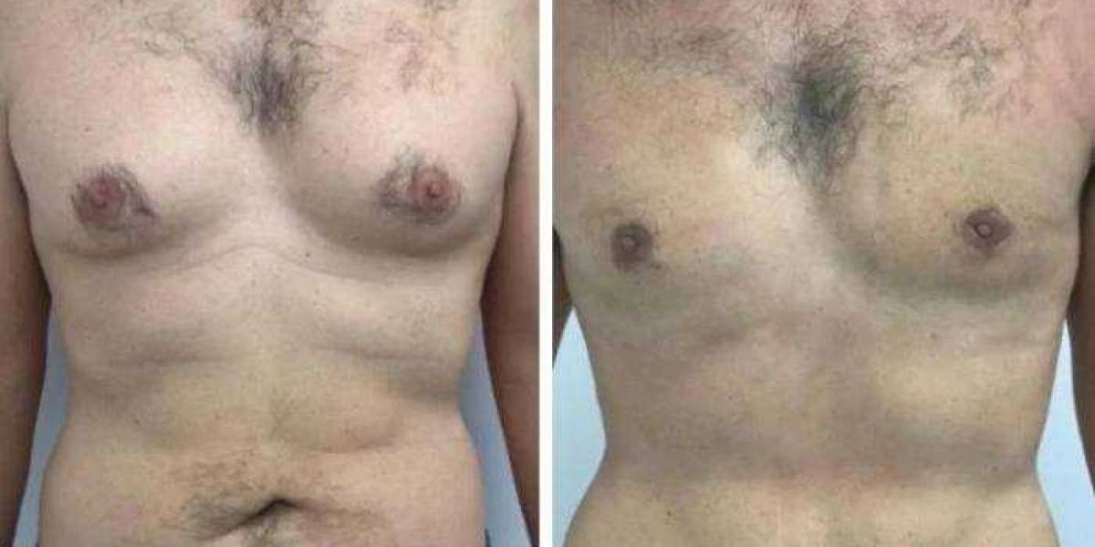 Gynecomastia in Dubai: Are Supplements Worth Considering