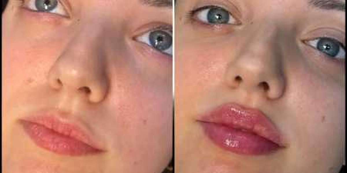 Are Fillers Treatments in Dubai Worth the Investment?