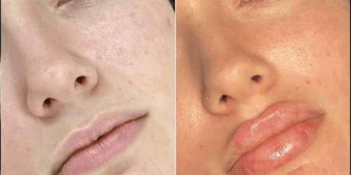 Achieve Youthful Skin with the Best Doctors in Dubai for Fillers