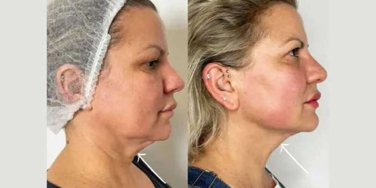How the Best Aesthetic Clinic in Dubai Gave Me Flawless Skin with Endolift