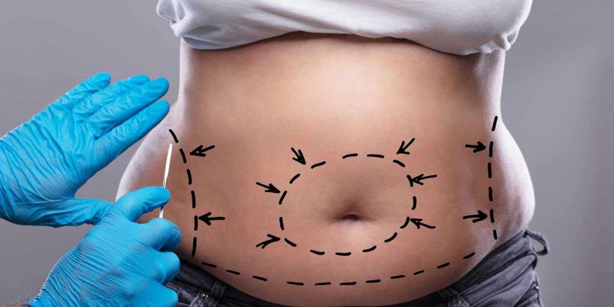 Before and After Tummy Tuck Dubai: Real Transformations