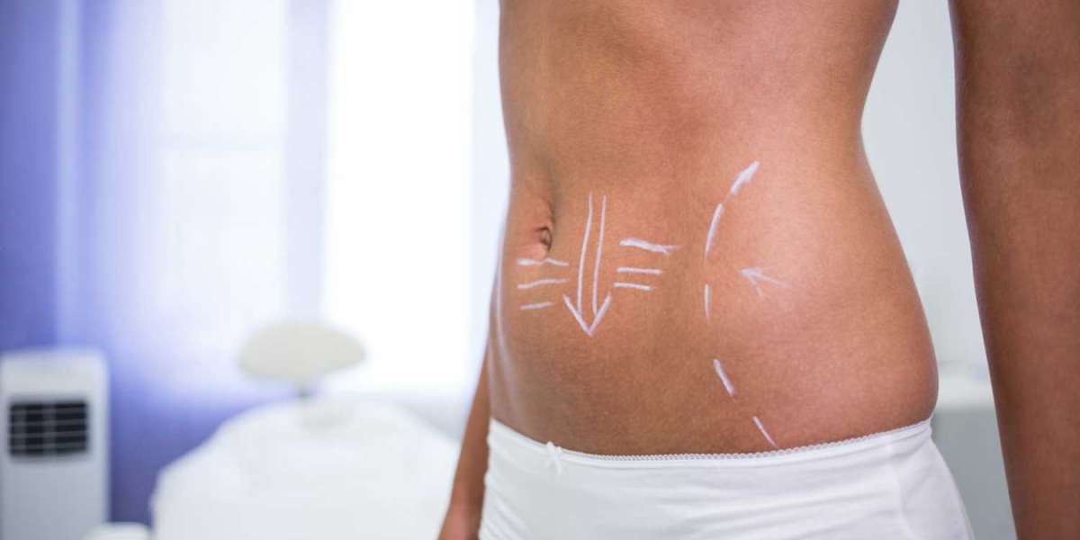 Is a Mini Tummy Tuck in Dubai Right for You? What You Need to Know