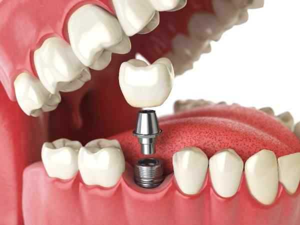 Dental implants Coventry