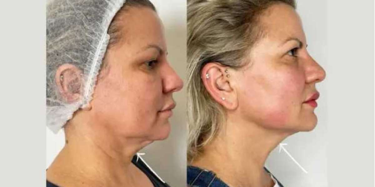Endolift Treatment in Dubai: Perfect Solution for Loose Skin