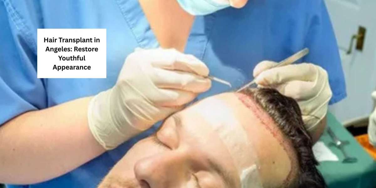 Hair transplant in los angeles: Restore Youthful Appearance